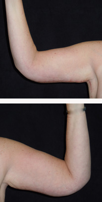 after arm lift front view case 3352