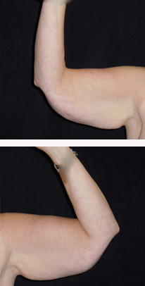 before arm lift front view case 3352