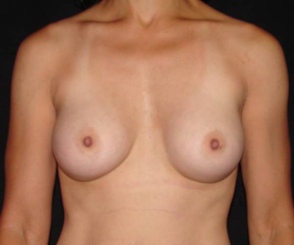 after breast augmentation front view female patient case 3605