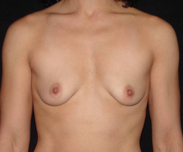 before breast augmentation front view female patient case 3605