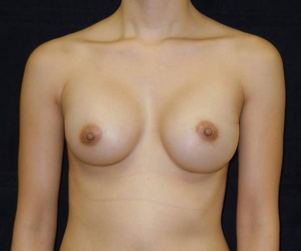 after breast augmentation front view female patient case 3615