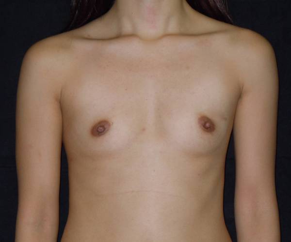 before breast augmentation front view female patient case 3615
