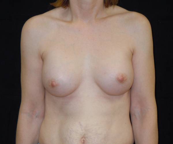 after breast augmentation front view female patient case 3620