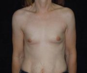 before breast augmentation front view female patient case 3620