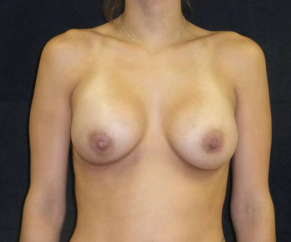 after breast augmentation front view female patient case 3625