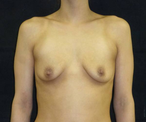 before breast augmentation front view female patient case 3625