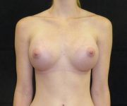 after breast augmentation front view female patient case 3630