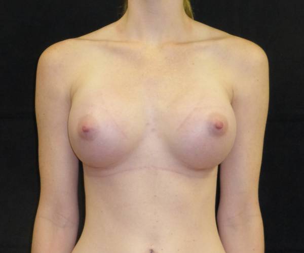 after breast augmentation front view female patient case 3630