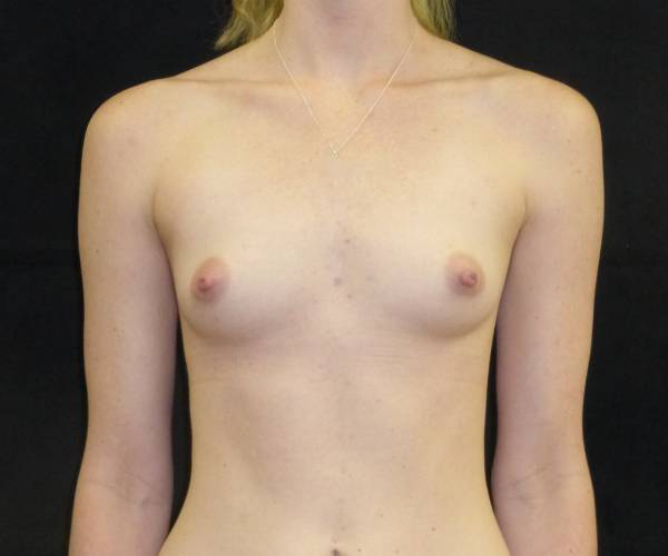 before breast augmentation front view female patient case 3630