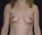 before breast augmentation front view female patient case 3636