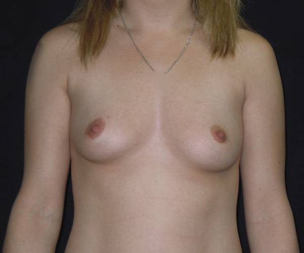 before breast augmentation front view female patient case 3636