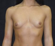 before breast augmentation front view female patient case 3641