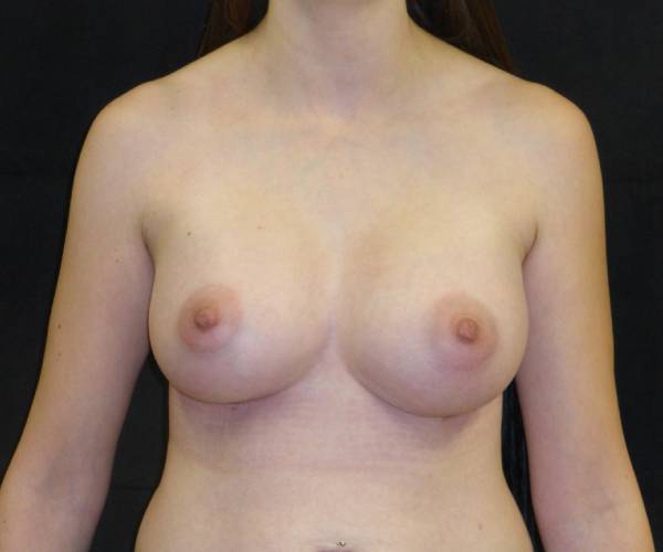 after breast augmentation front view female patient case 3651