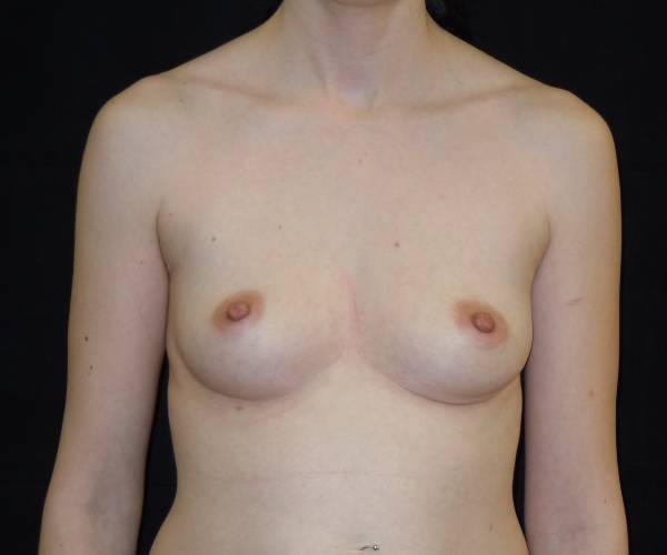 before breast augmentation front view female patient case 3651