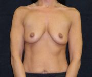 before breast augmentation front view female patient case 3656