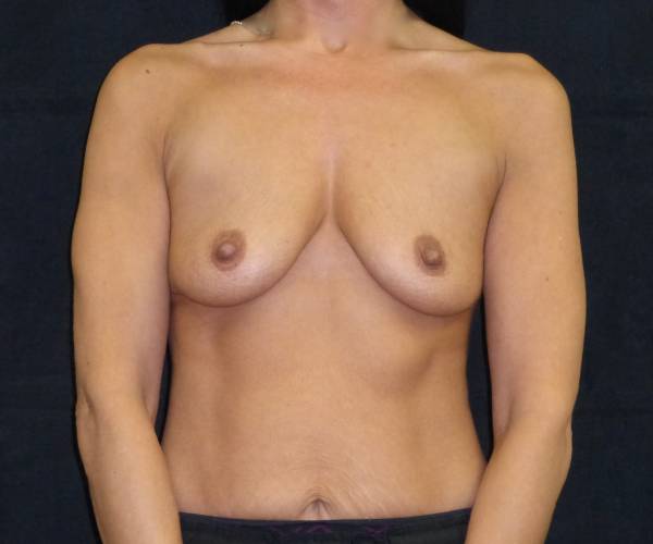 before breast augmentation front view female patient case 3656