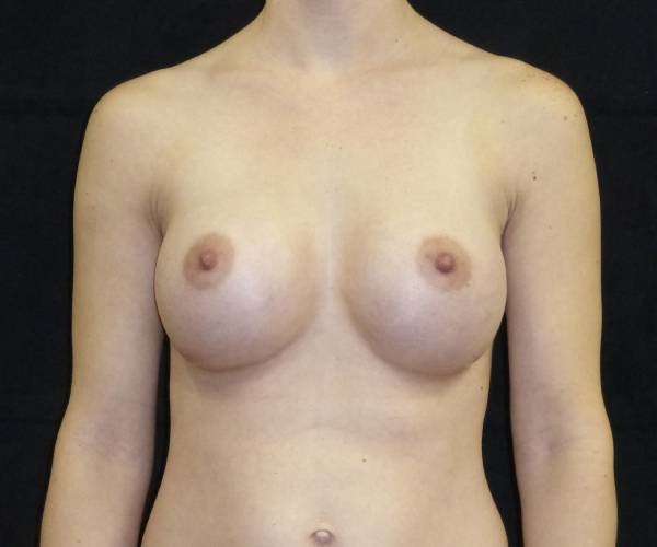 after breast augmentation front view female patient case 3666