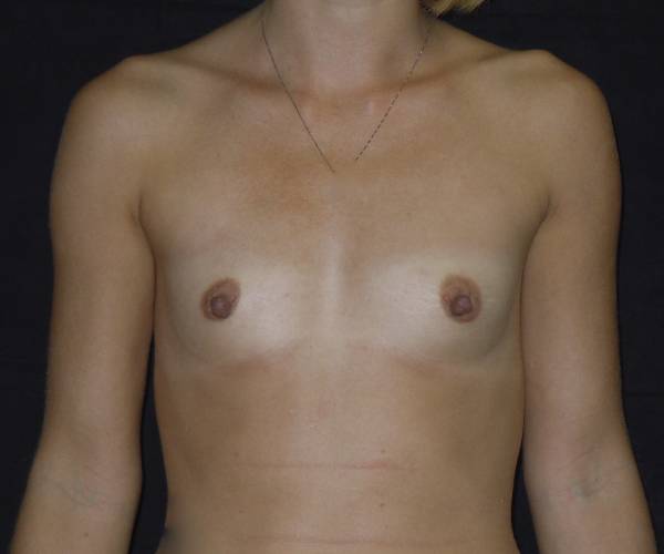 before breast augmentation front view female patient case 3671