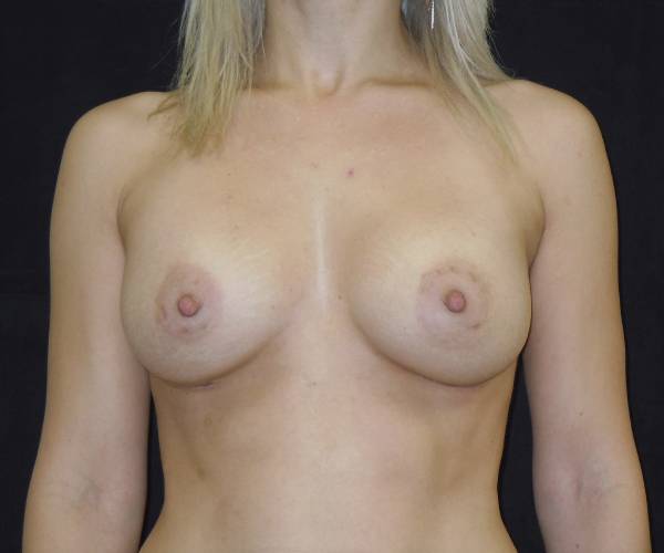 after breast augmentation front view female patient case 3676