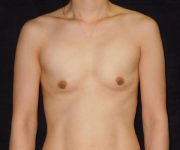 before breast augmentation front view female patient case 3686