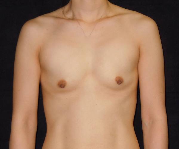 before breast augmentation front view female patient case 3686