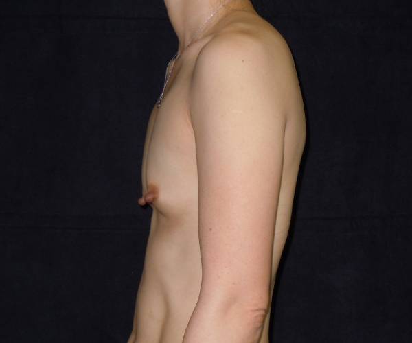 before breast augmentation left view female patient case 3686
