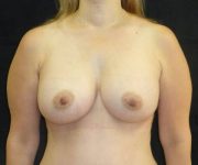 after breast augmentation front view female patient case 3696