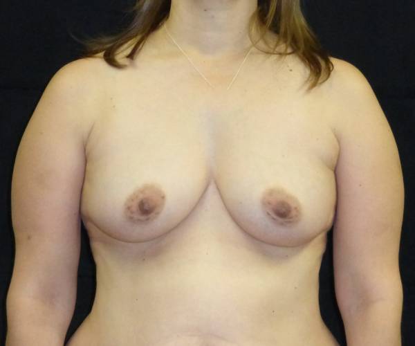 before breast augmentation front view female patient case 3696