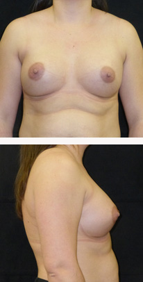after breast augmentation front & right view female patient case 3763
