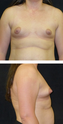 before breast augmentation front & right view female patient case 3763