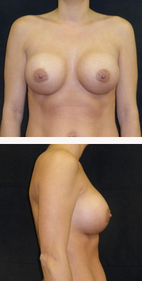 after breast augmentation front & right view female patient case 3766