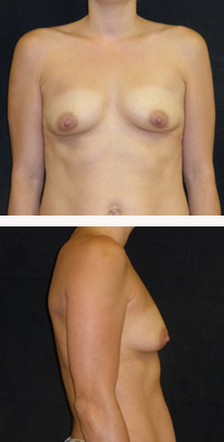 before breast augmentation front & right view female patient case 3766