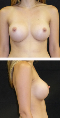 after breast augmentation front & right view female patient case 3771