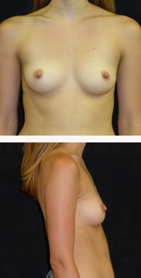 before breast augmentation front & right view female patient case 3771
