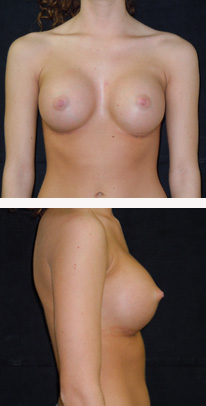 after breast augmentation front & right view female patient case 3776