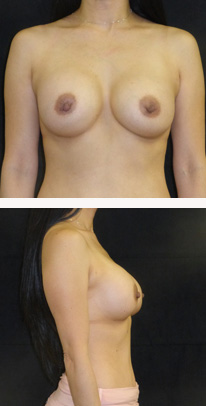 after breast augmentation front & right view female patient case 3779