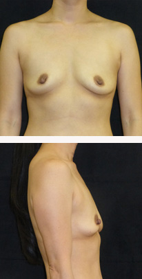 before breast augmentation front & right view female patient case 3779