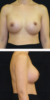after breast augmentation front & right view female patient case 3782