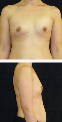 before breast augmentation front & right view female patient case 3782