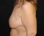 before breast augmentation with lift left view female patient case 3786
