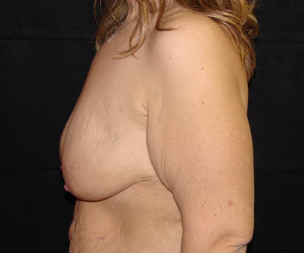 before breast augmentation with lift left view female patient case 3786