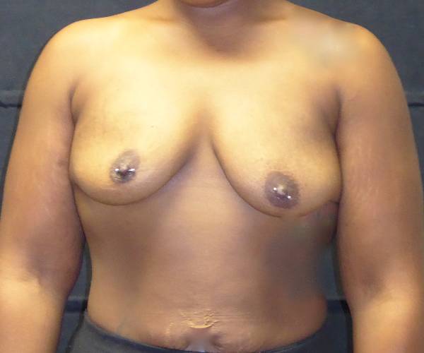 before breast augmentation with lift front view female patient case 3791