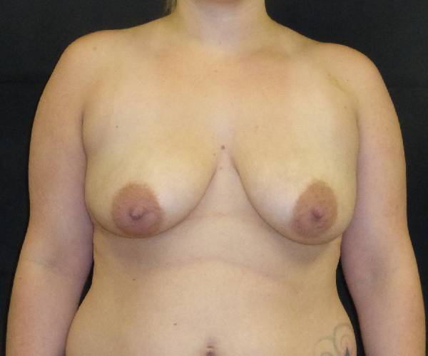 before breast augmentation with lift front view female patient case 3796