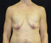 before breast augmentation with lift front view female patient case 3801