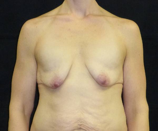 before breast augmentation with lift front view female patient case 3801