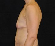 before breast augmentation with lift left view female patient case 3801
