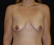 before breast augmentation with lift front view female patient case 3811