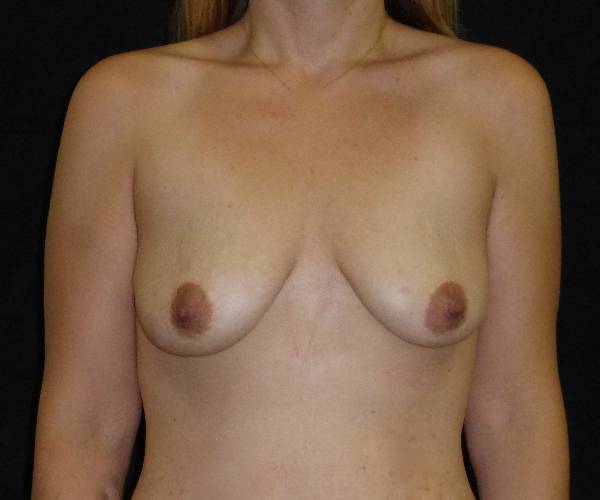 before breast augmentation with lift front view female patient case 3811