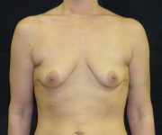 before breast augmentation with lift front view female patient case 3816