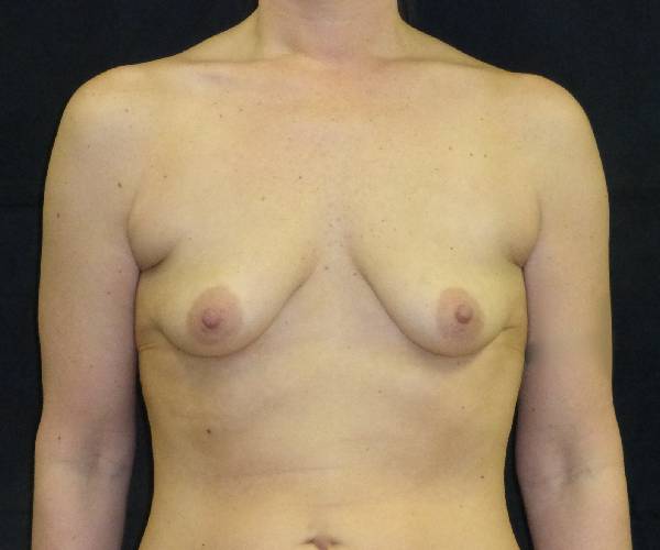 before breast augmentation with lift front view female patient case 3816